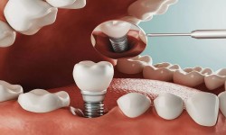 Balm Dental Care Centre  - Dental Implant At Balm Dental Care