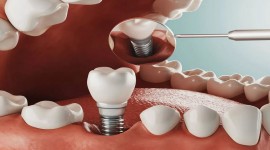 Balm Dental Care Centre  - Dental Implant At Balm Dental Care