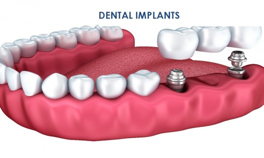 Dove Dental Clinic - DENTAL IMPLANTS IN THIKA