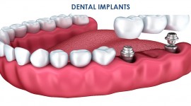 Dove Dental Clinic - DENTAL IMPLANTS IN THIKA