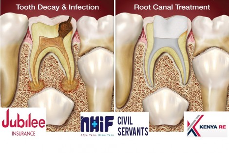 Dove Dental Clinic - ROOT CANAL TREATMENT IN THIKA