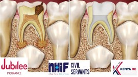 Dove Dental Clinic - ROOT CANAL TREATMENT IN THIKA