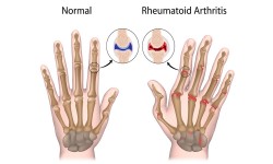 Dr. Paul Etau Ekwom - RHEUMATOID ARTHRITIS TREATMENT IN KENYA