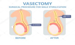 Dr Onyango Oluoch - Urologist - VASECTOMY SERVICES IN NAIROBI