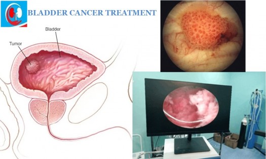 Dr Onyango Oluoch - Urologist - BLADDER CANCER TREATMENT IN NAIROBI
