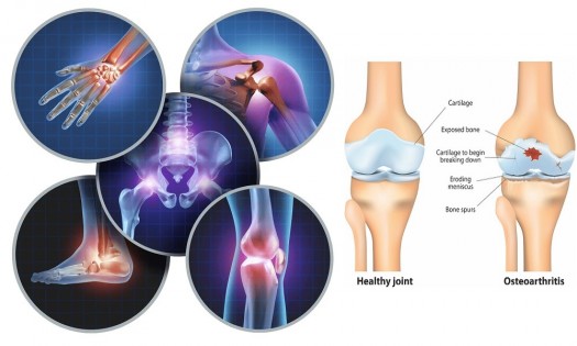 Dr. Paul Etau Ekwom - OSTEOARTHRITIS TREATMENT IN KENYA