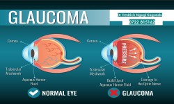 Dr Fredrick Ngugi Kagondu - Ophthalmologist  - GLAUCOMA TREATMENT THIKA, KIAMBU