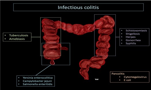 Dr Stephen Mbugua Kairu - COLITIS TREATMENT IN KENYA