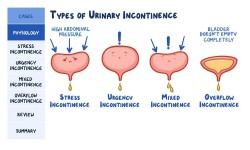 Dr Onyango Oluoch - Urologist - URINARY INCONTINENCE TREATMENT IN KENYA