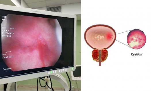 DR ONYANGO OLUOCH - UROLOGIST -  Interstitial Cystitis Treatment Nairobi