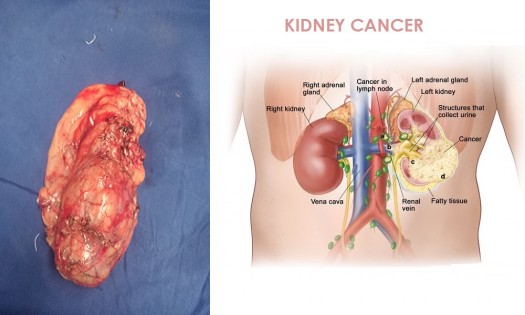 DR ONYANGO OLUOCH - UROLOGIST - KIDNEY CANCER TREATMENT IN NAIROBI