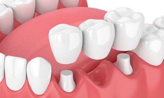 Balm Dental Care  - RESTORATIVE DENTISTRY NAIROBI