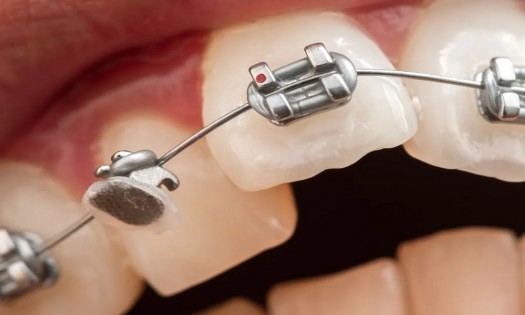 Balm Dental Care  - METALLIC BRACES BRACKETS TREATMENT IN NAIROBI
